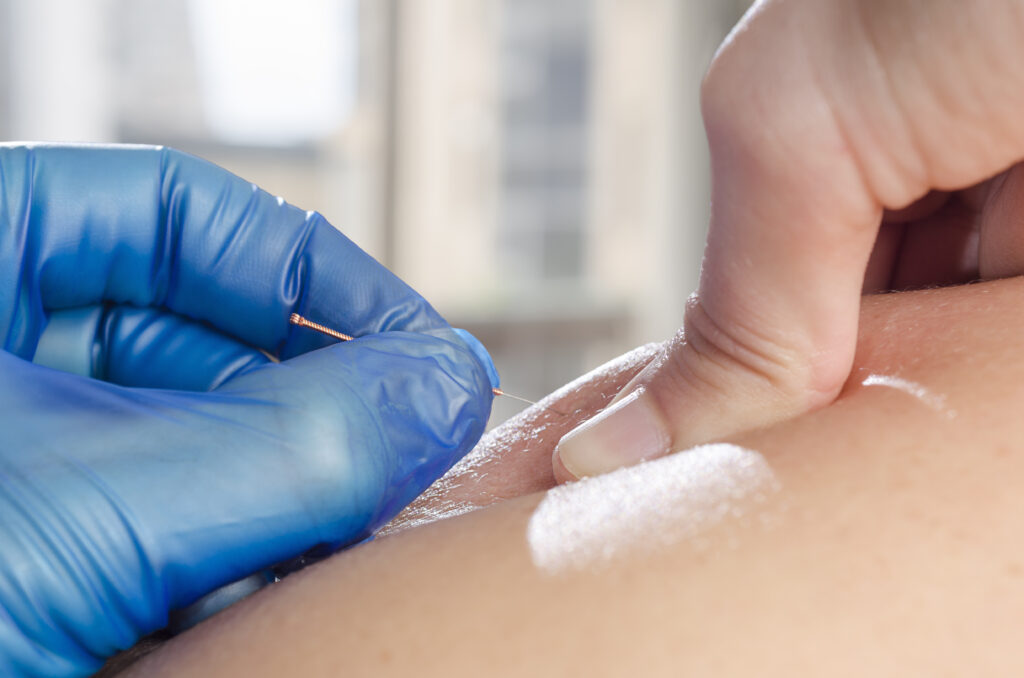 Dry Needling Behandlung bei MOVENDUS Praxis für Physiotherapie, Osteopathie & HPPsychotherapie in Hamburg-Winterhude